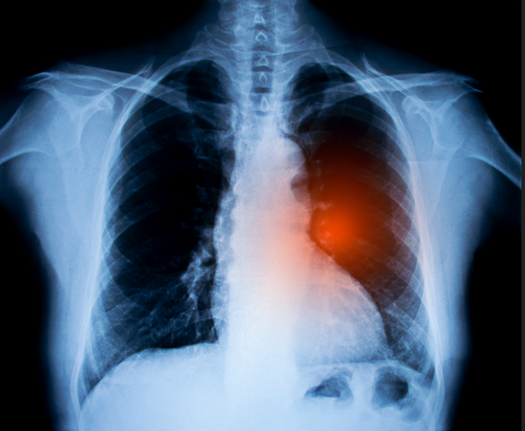Lung Cancer